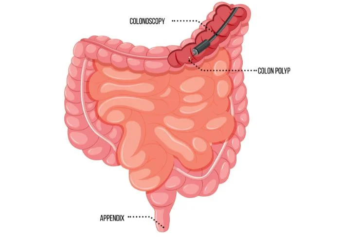 scopedigestiveclinic Colonoscopy